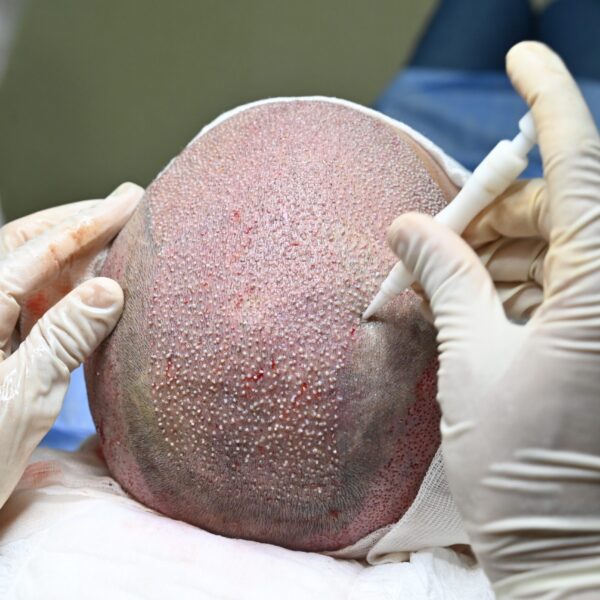 DHI Hair Transplant Method