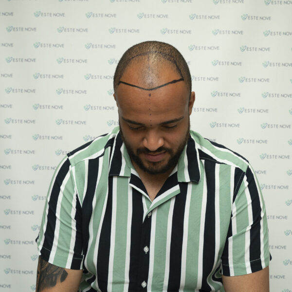 Male Pattern Baldness