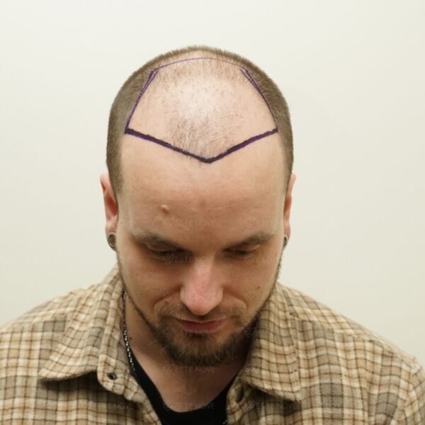 Front view of a patient with low hair density and marked donor/recipient areas for hair transplant planning.