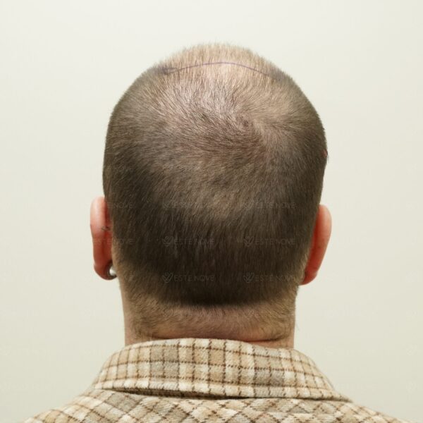 Back view showing visible scalp due to low follicle density per square inch.
