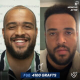 before and 11 months after photos of a man with hair transplant, 4100 grafts and FUE method used