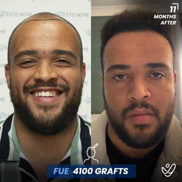 before and 11 months after photos of a man with hair transplant, 4100 grafts and FUE method used