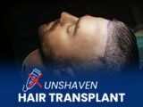 Man in a hair transplantation procedure with text saying unshaven hair transplant