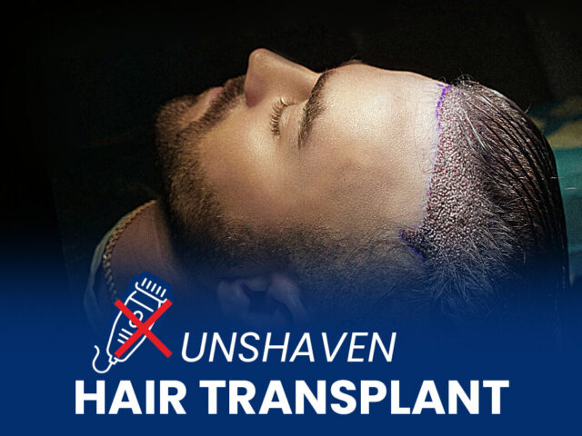 Man in a hair transplantation procedure with text saying unshaven hair transplant