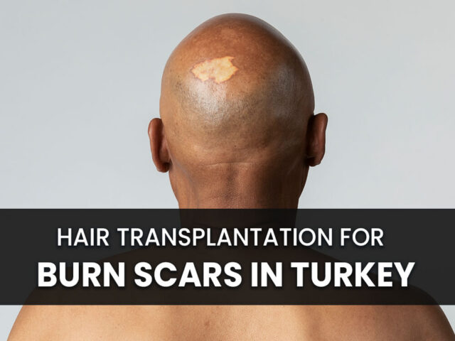 Bald man with burn scar in his head and text saying Hair Transplantation for Burn Scars in Turkey