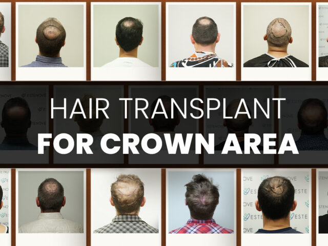 Text saying hair transplant for crown area with bald men photos