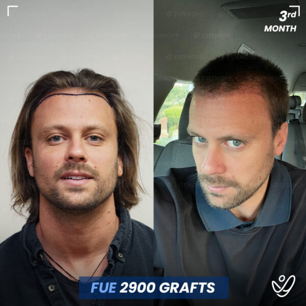 Male, FUE, 3 Months After Hair Transplant, 2900 Grafts