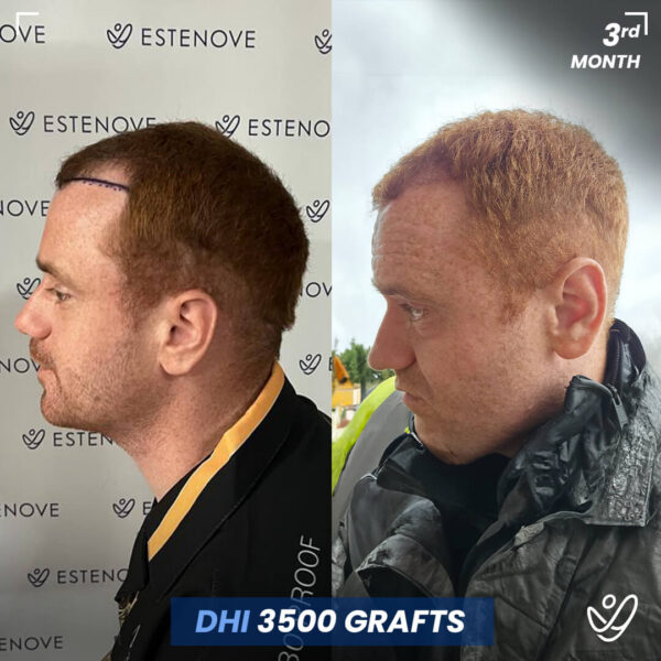 Male, DHI, 3 Months After Hair Transplant, 3500 Grafts