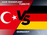 Germany vs Turkey for Hair Transplants