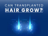Can Transplanted Hair Grow