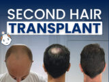 Second Hair Transplants Explained