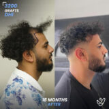 3200 Grafts Hair Transplant Before After - Right Side