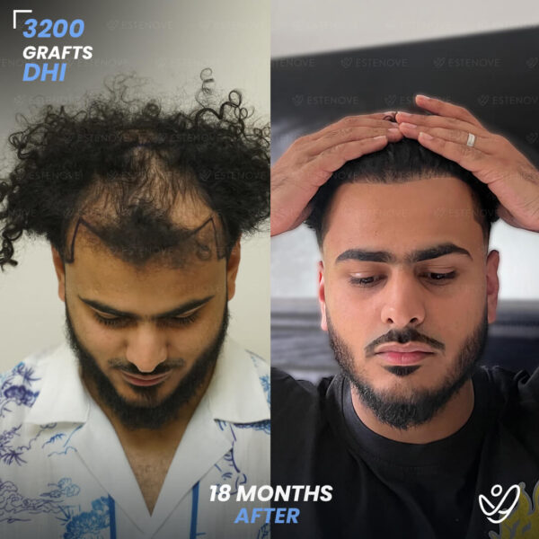 3200 Grafts Hair Transplant Before After - Hairline and Front