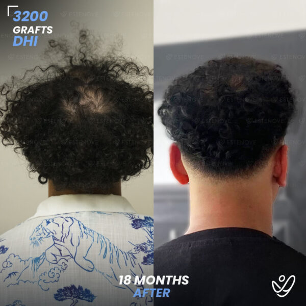 3200 Grafts Hair Transplant Before After - Crown