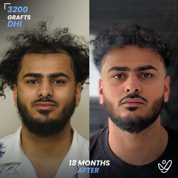 3200 Grafts Hair Transplant Before After