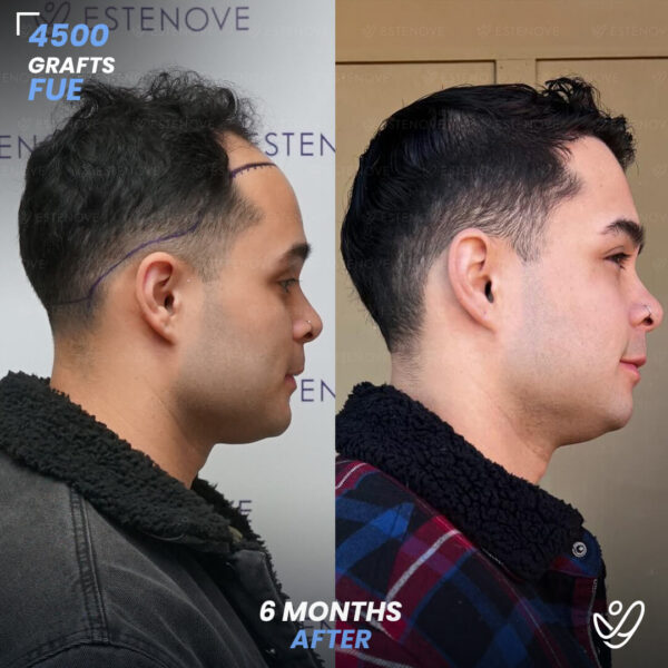 FUE 4500 Graft Hair Transplant 6 Months Before After