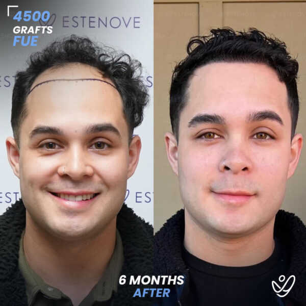FUE 4500 Graft Hair Transplant 6 Months Before After