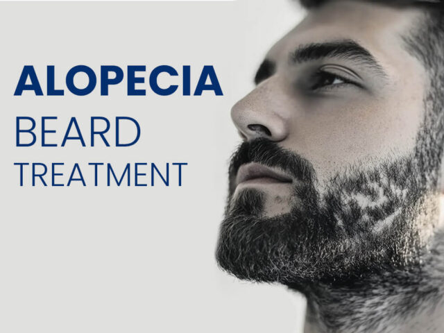 Alopecia Beard Treatment