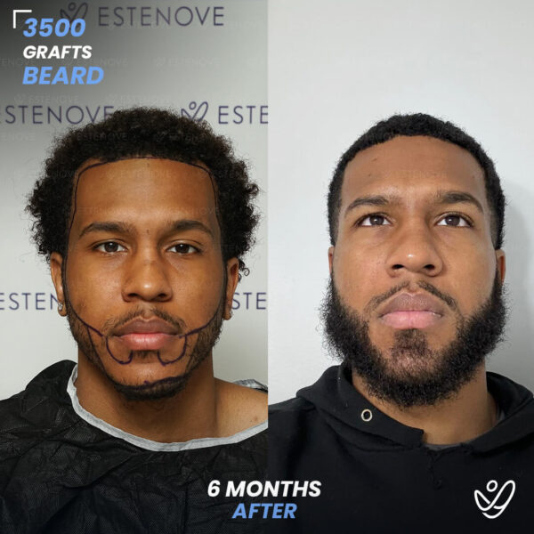 Beard transplant - 3500 grafts - 6 months before after