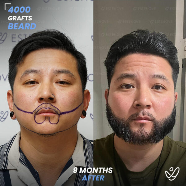 Beard transplant - 4000 grafts - 9 months before after