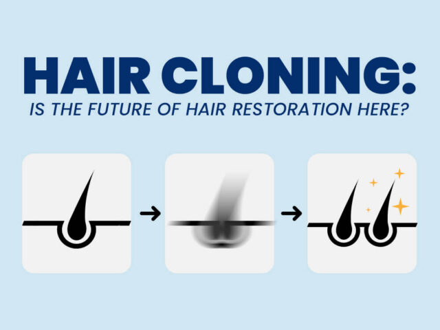 Hair Cloning- Is the Future of Hair Restoration Here