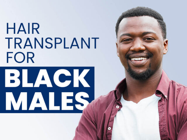 Hair Transplant for Black Males