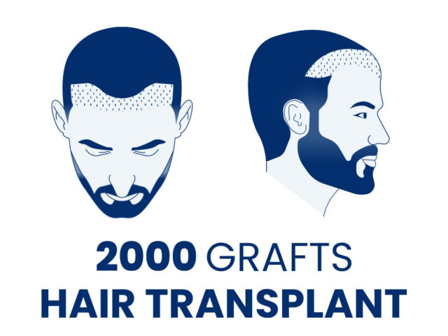 2000 Grafts Hair Transplant
