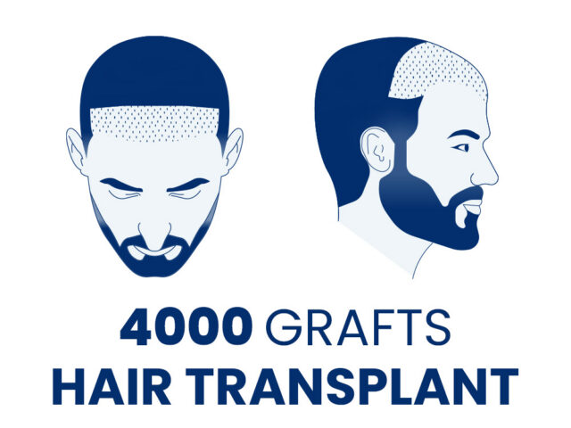 4000 Grafts Hair Transplant