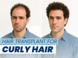 Hair Transplant for Curly Hair