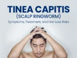 Man holding his head with text "Tinea Capitis (Scalp Ringworm): Symptoms, Treatment, and Hair Loss Risks."