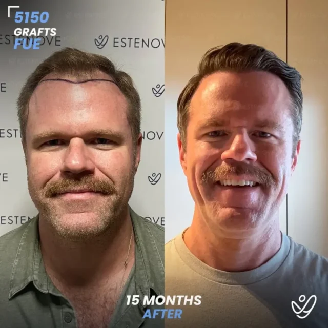 FUE 5150 Graft Hair Transplant Before After - Front