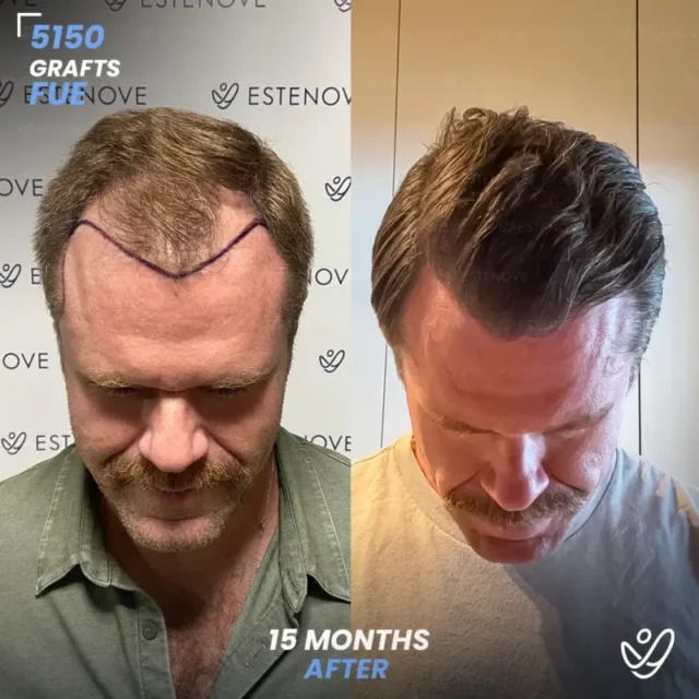 FUE 5150 Graft Hair Transplant Before After - Crown