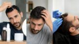 prp vs minoxidile vs finasteride